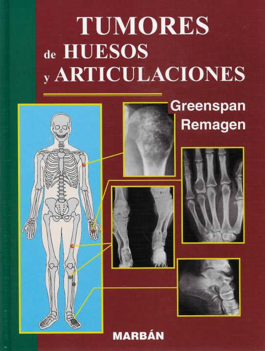 Tumores de Huesos y articulaciones